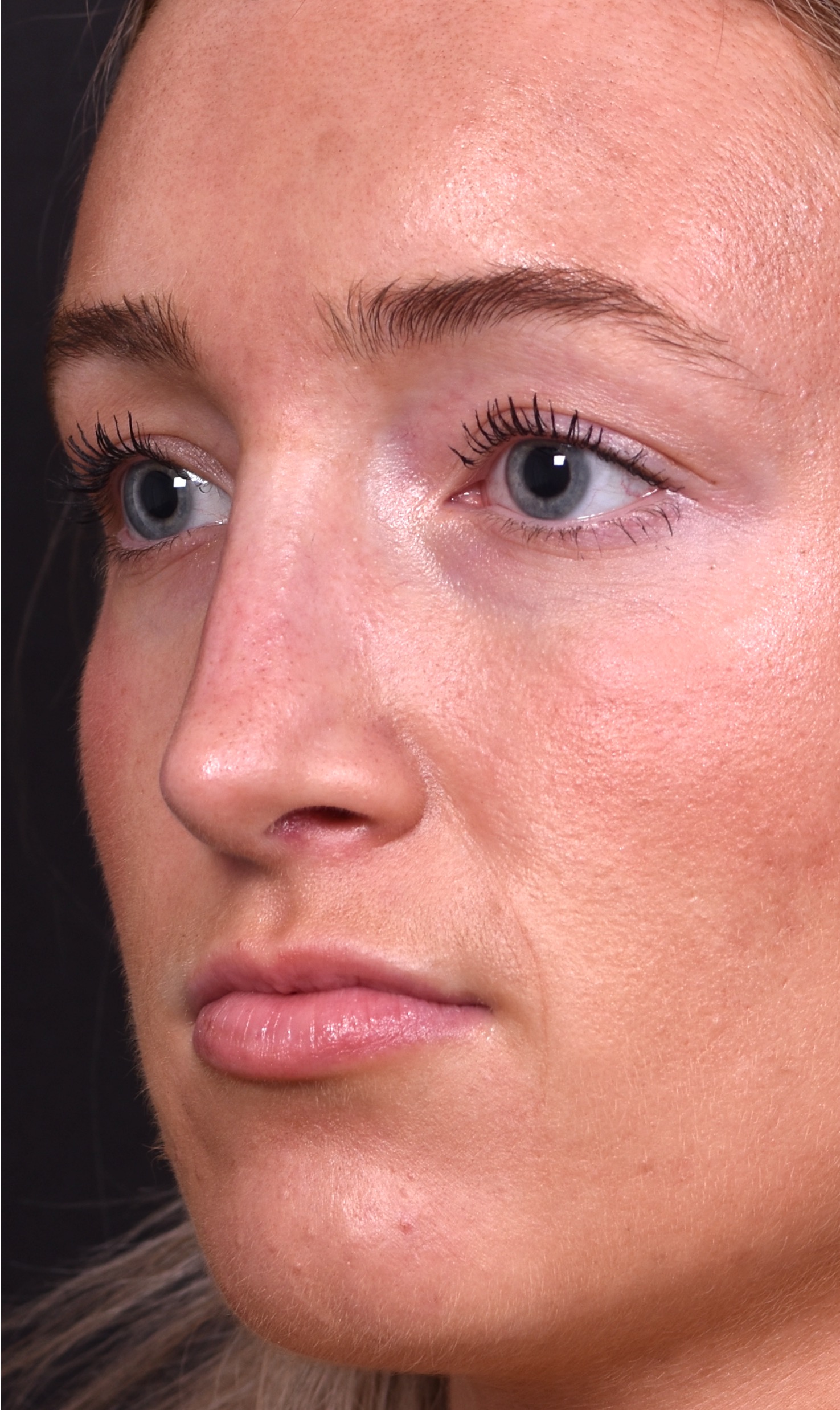 Atlanta preservation rhinoplasty ultrasonic before after expert top Atlanta nose job best