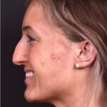 Atlanta preservation rhinoplasty ultrasonic before after expert top Atlanta nose job best
