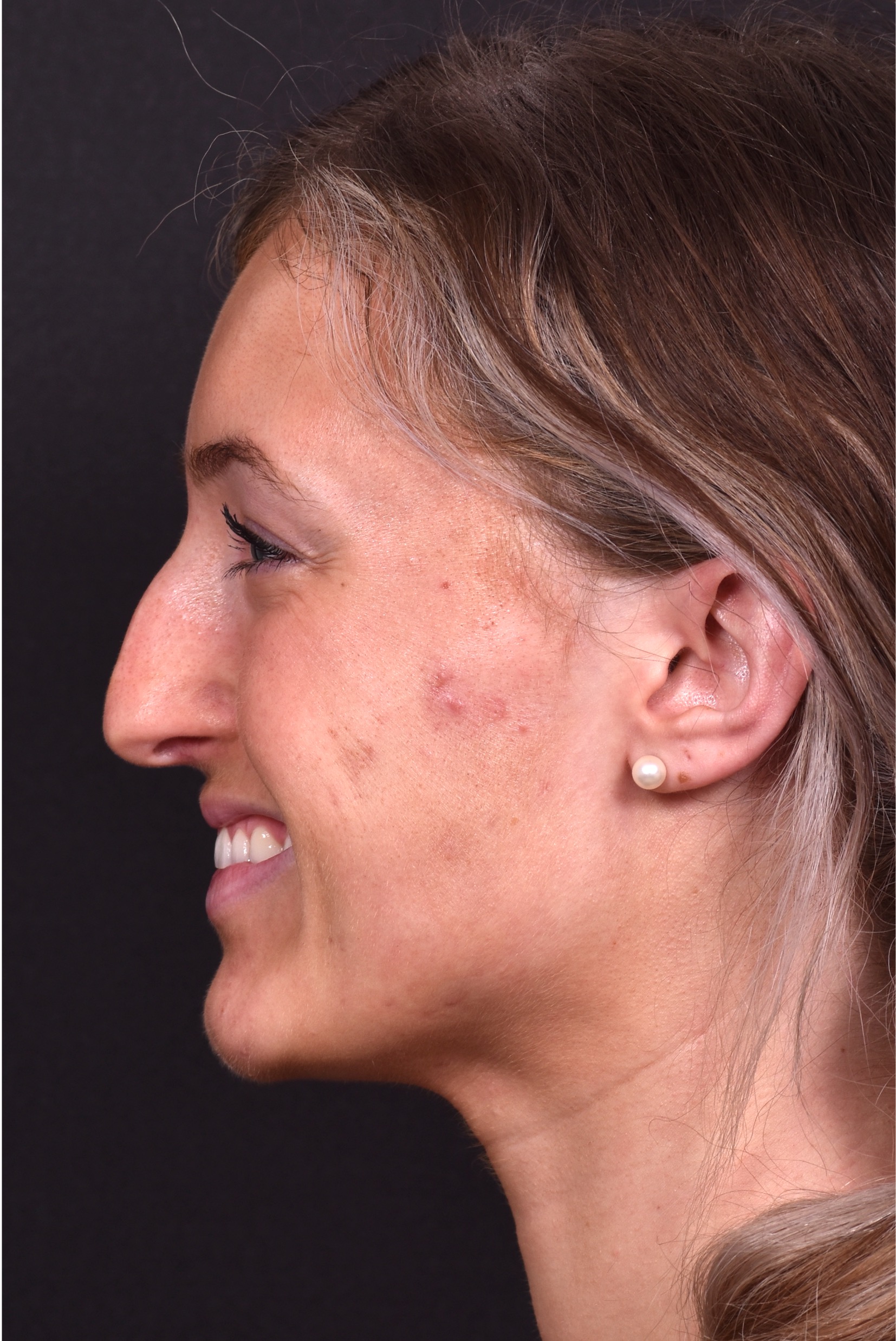 Atlanta preservation rhinoplasty ultrasonic before after expert top Atlanta nose job best