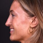 Atlanta preservation rhinoplasty ultrasonic before after expert top Atlanta nose job best