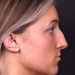 Atlanta preservation rhinoplasty ultrasonic before after expert top Atlanta nose job best