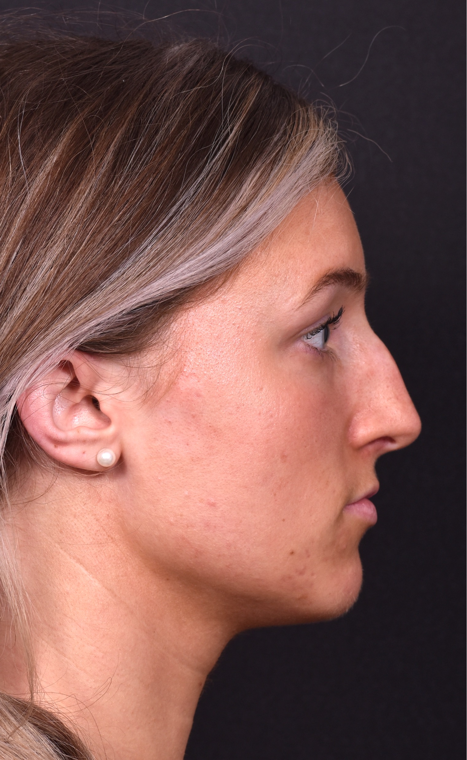 Atlanta preservation rhinoplasty ultrasonic before after expert top Atlanta nose job best