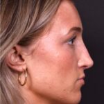 Atlanta preservation rhinoplasty ultrasonic before after expert top Atlanta nose job best