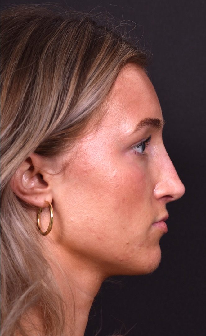 Atlanta preservation rhinoplasty ultrasonic before after expert top Atlanta nose job best