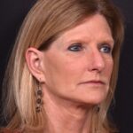 Aviva Atlanta brow lift forehead eyelid blepharoplasty lidlift best expert before after