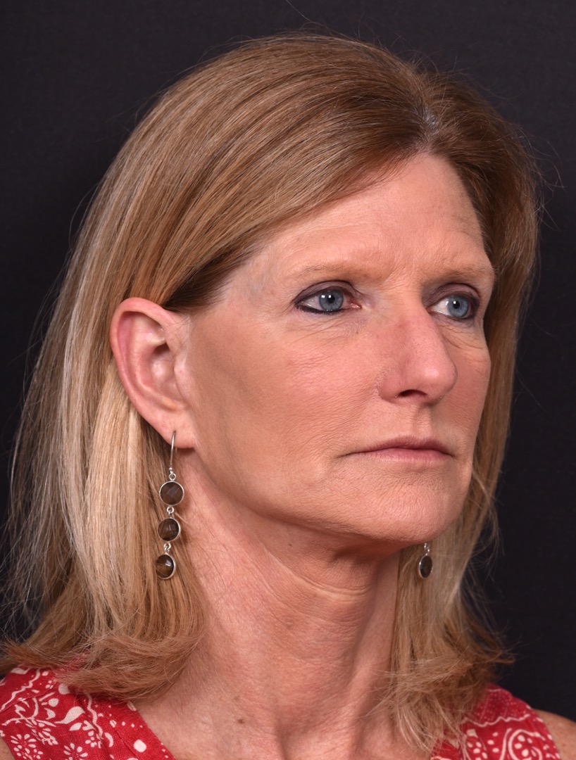 Aviva Atlanta brow lift forehead eyelid blepharoplasty lidlift best expert before after