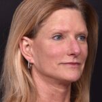 Aviva Atlanta brow lift forehead eyelid blepharoplasty lidlift best expert before after