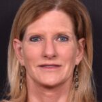Aviva Atlanta brow lift lidlift face expert best before after plastic surgeon