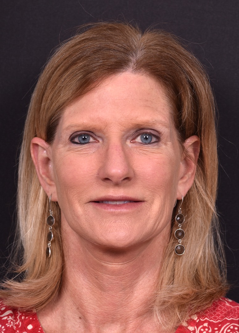 Aviva Atlanta brow lift lidlift face expert best before after plastic surgeon