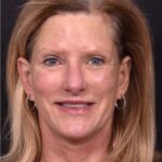 Aviva Atlanta brow lift lidlift face expert best before after plastic surgeon