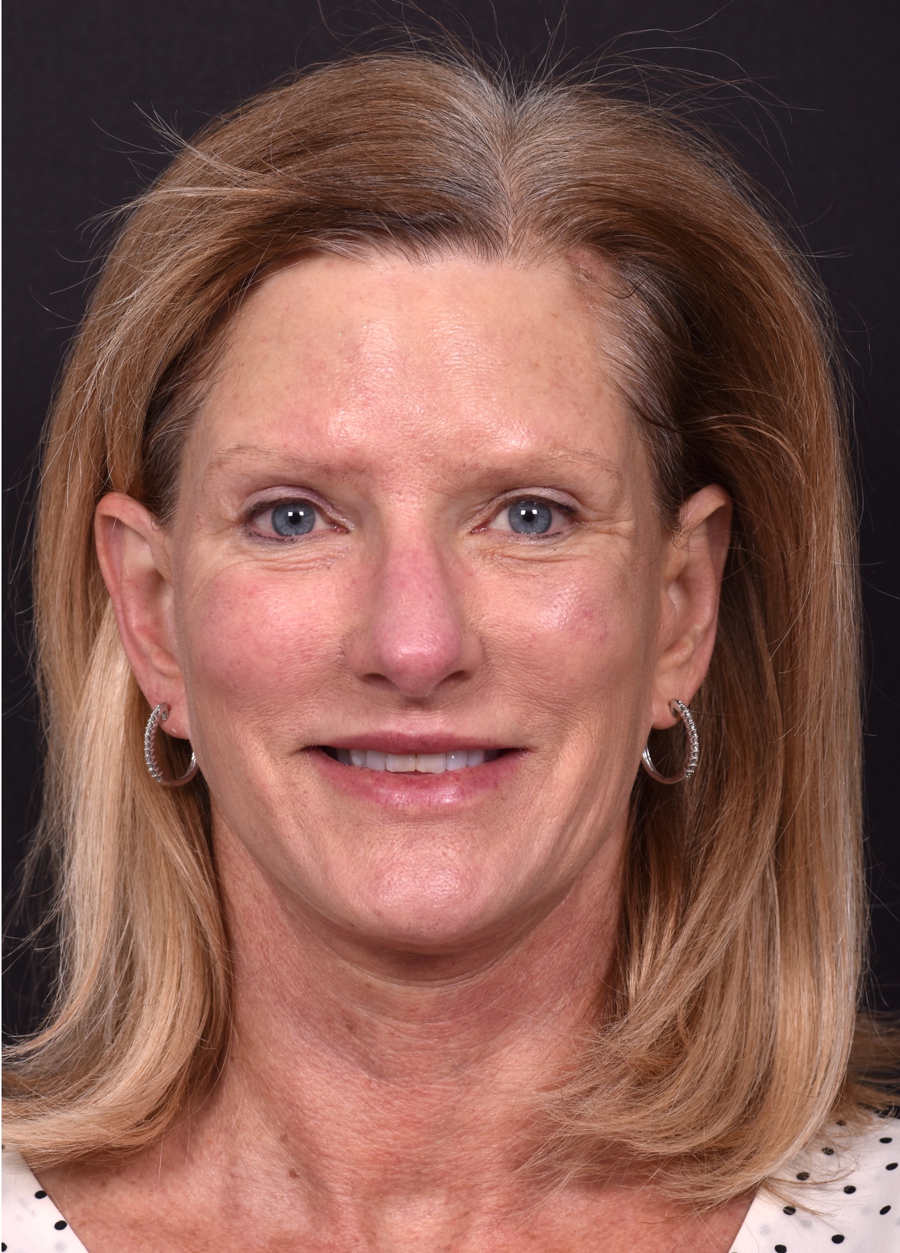 Aviva Atlanta brow lift lidlift face expert best before after plastic surgeon