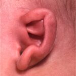 Aviva Atlanta newborn baby ear treatment correction Earwell deformity congenital best expert