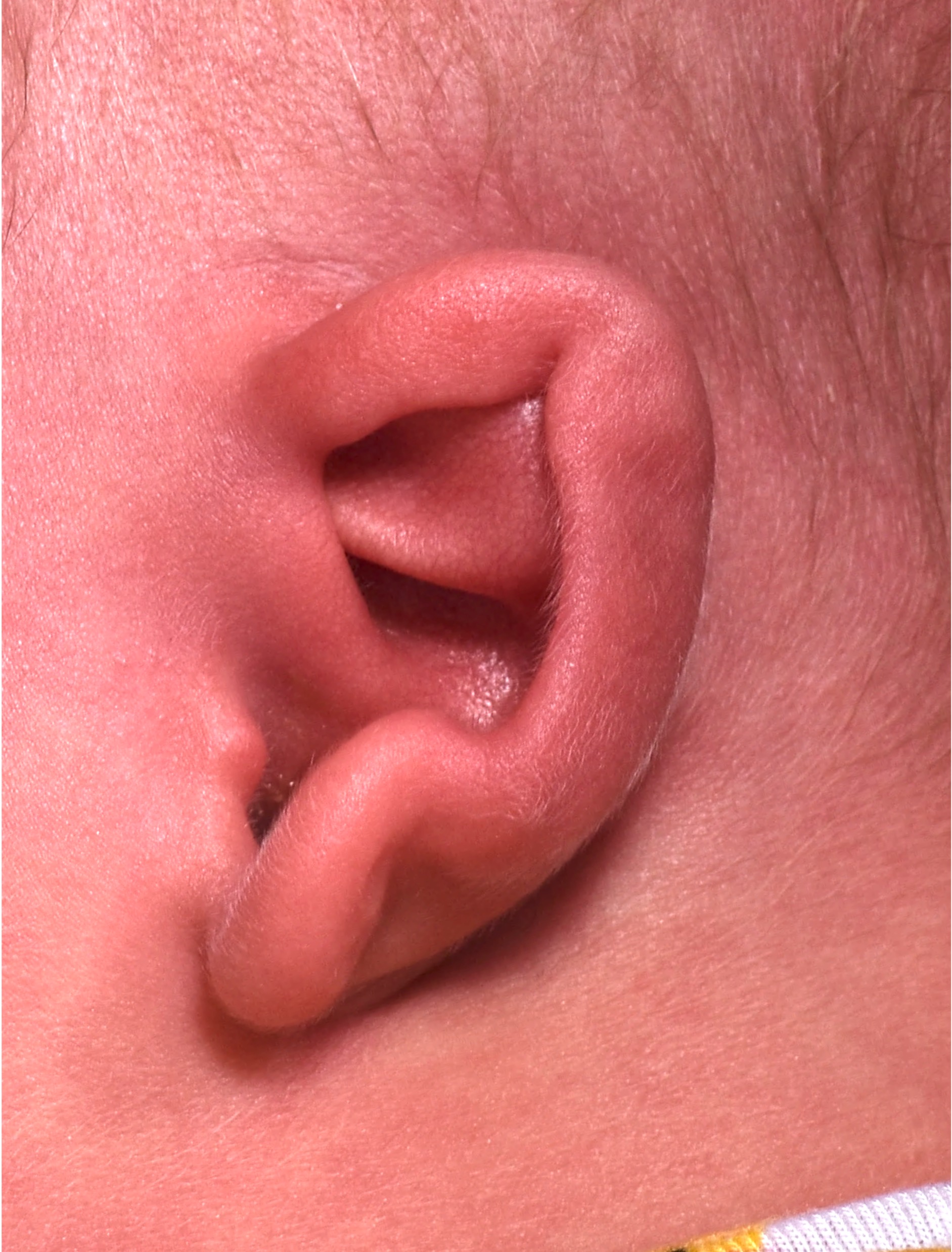 Aviva Atlanta newborn baby ear treatment correction Earwell deformity congenital best expert