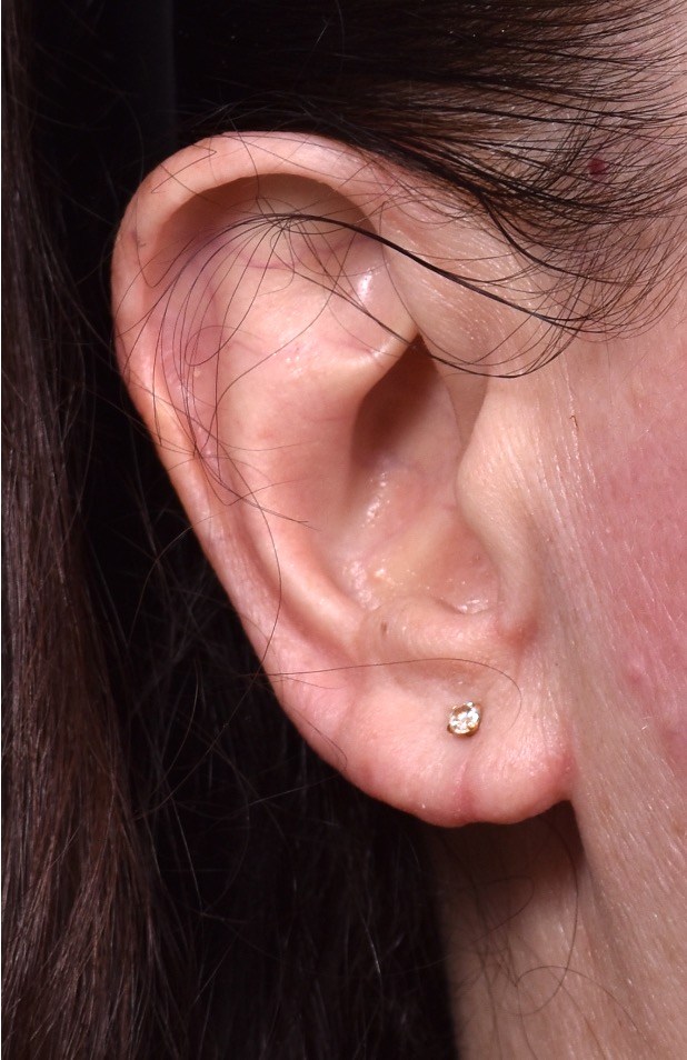 Aviva earlobe reduction piercing stretched repair best expert