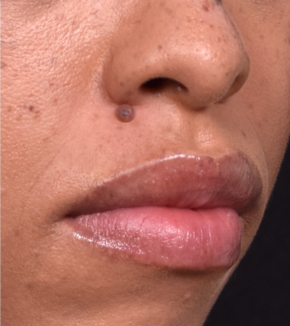 Atlanta mole birthmark treatment surgery scarless best before after