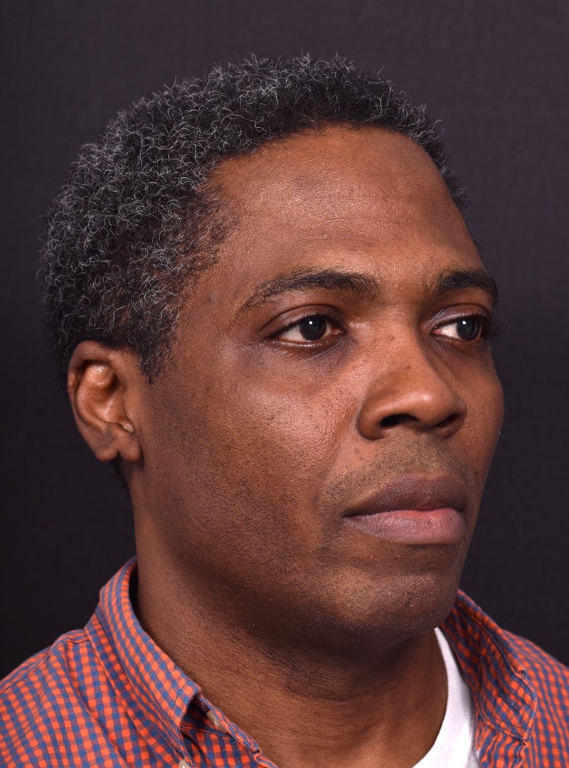 Aviva Atlanta lipoma forehead bump fat treatment scarless best