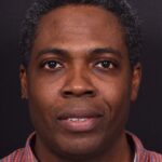 Aviva Atlanta lipoma forehead bump fat treatment scarless best