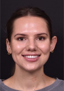 Atlanta otoplasty Aviva ear surgery before after best expert pinning