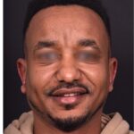Atlanta otoplasty before after best expert surgery treatment ear pinning