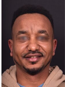 Atlanta otoplasty before after best expert surgery treatment ear pinning