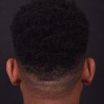 Atlanta otoplasty before after best expert surgery treatment ear pinning