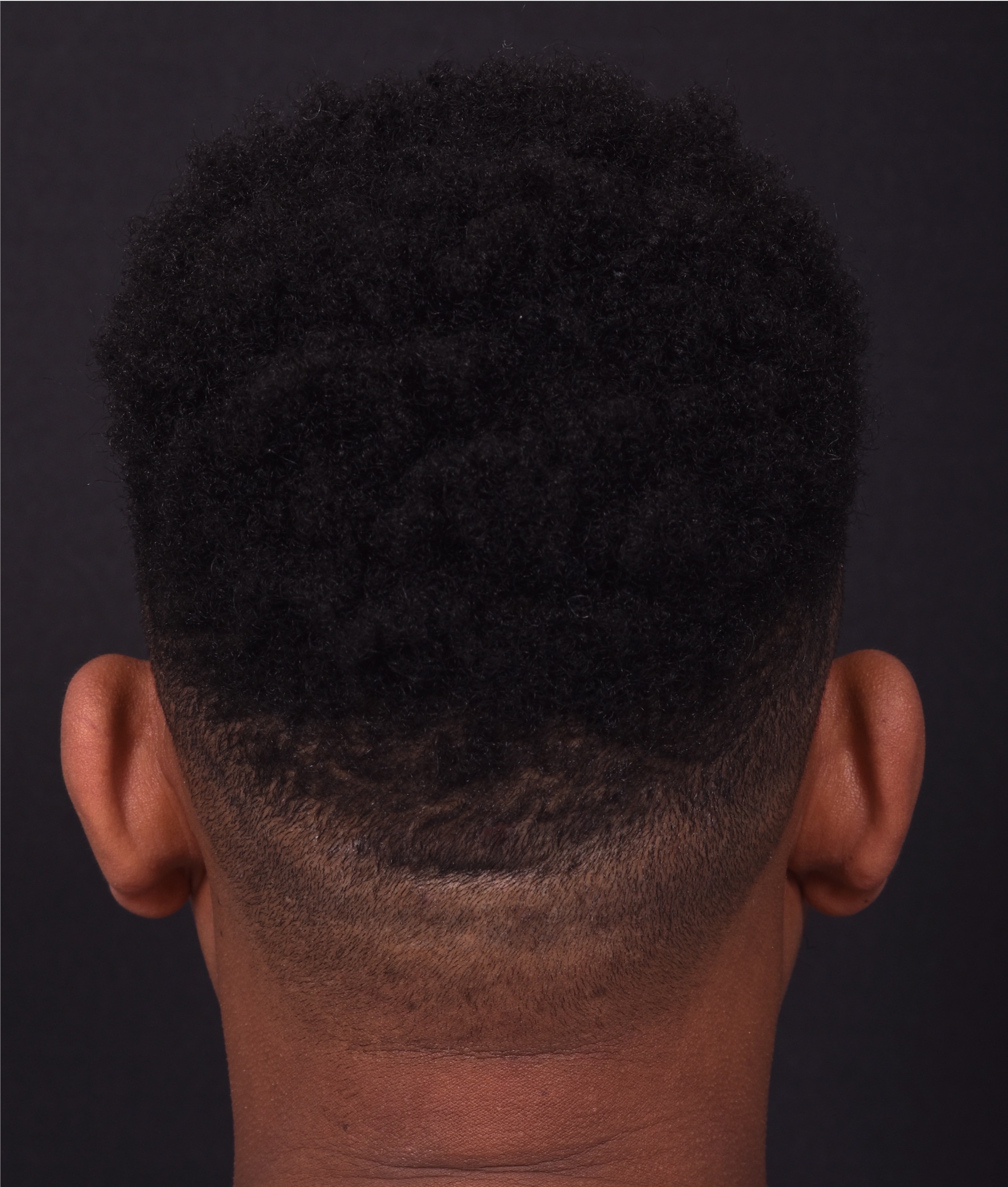 Atlanta otoplasty before after best expert surgery treatment ear pinning