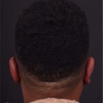 Atlanta otoplasty before after best expert surgery treatment ear pinning