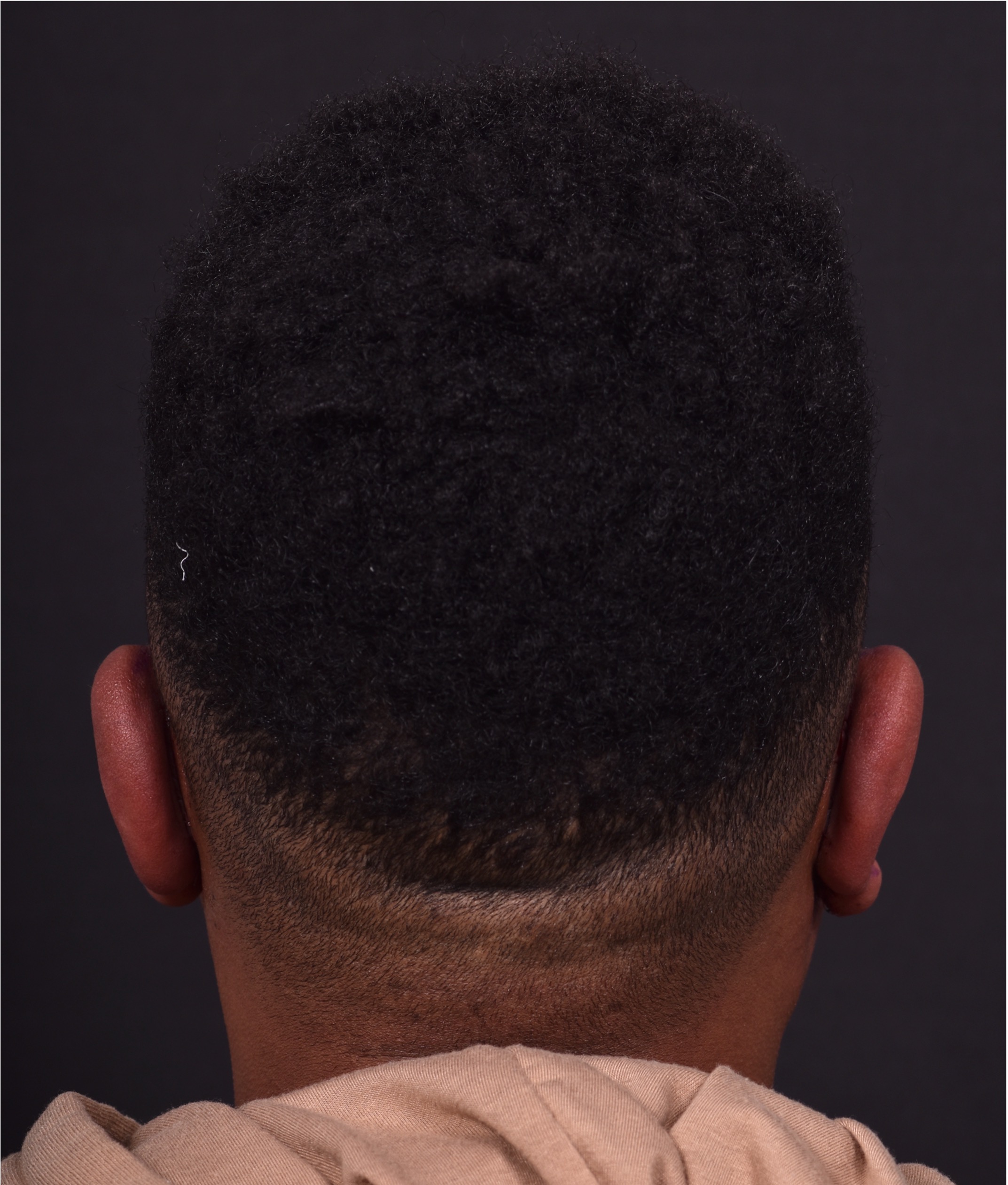 Atlanta otoplasty before after best expert surgery treatment ear pinning