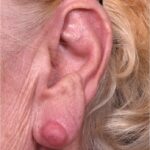 Atlanta keloid treatment surgery injections best scar revision expert