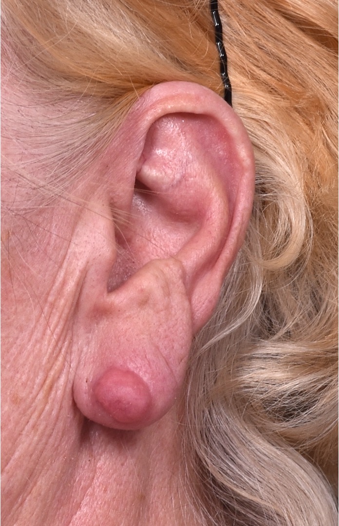 Atlanta keloid treatment surgery injections best scar revision expert