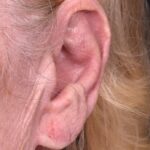 Atlanta keloid treatment surgery injections best scar revision expert