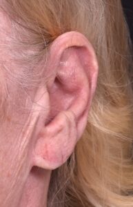 Atlanta keloid treatment surgery injections best scar revision expert