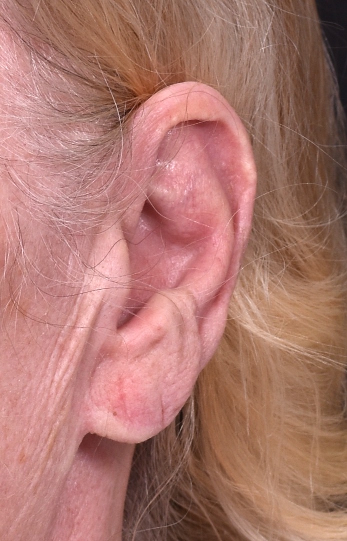 Atlanta keloid treatment surgery injections best scar revision expert