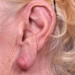 Atlanta keloid treatment surgery injections best scar revision expert