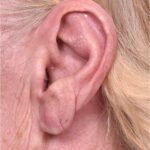 Atlanta keloid treatment surgery injections best scar revision expert