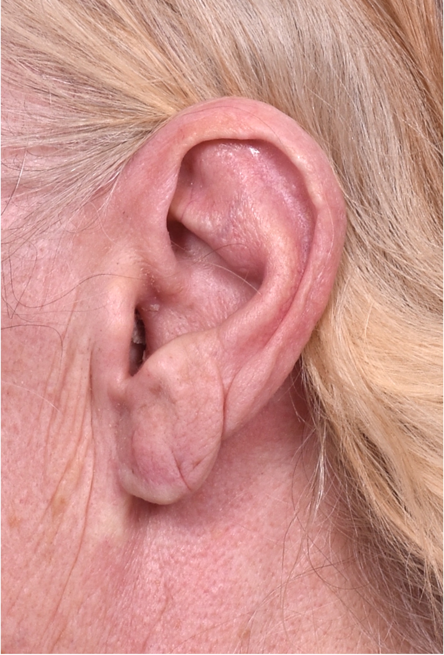 Atlanta keloid treatment surgery injections best scar revision expert