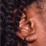 Earlobe repair torn stretched piercing Atlanta best Sandy Springs before after