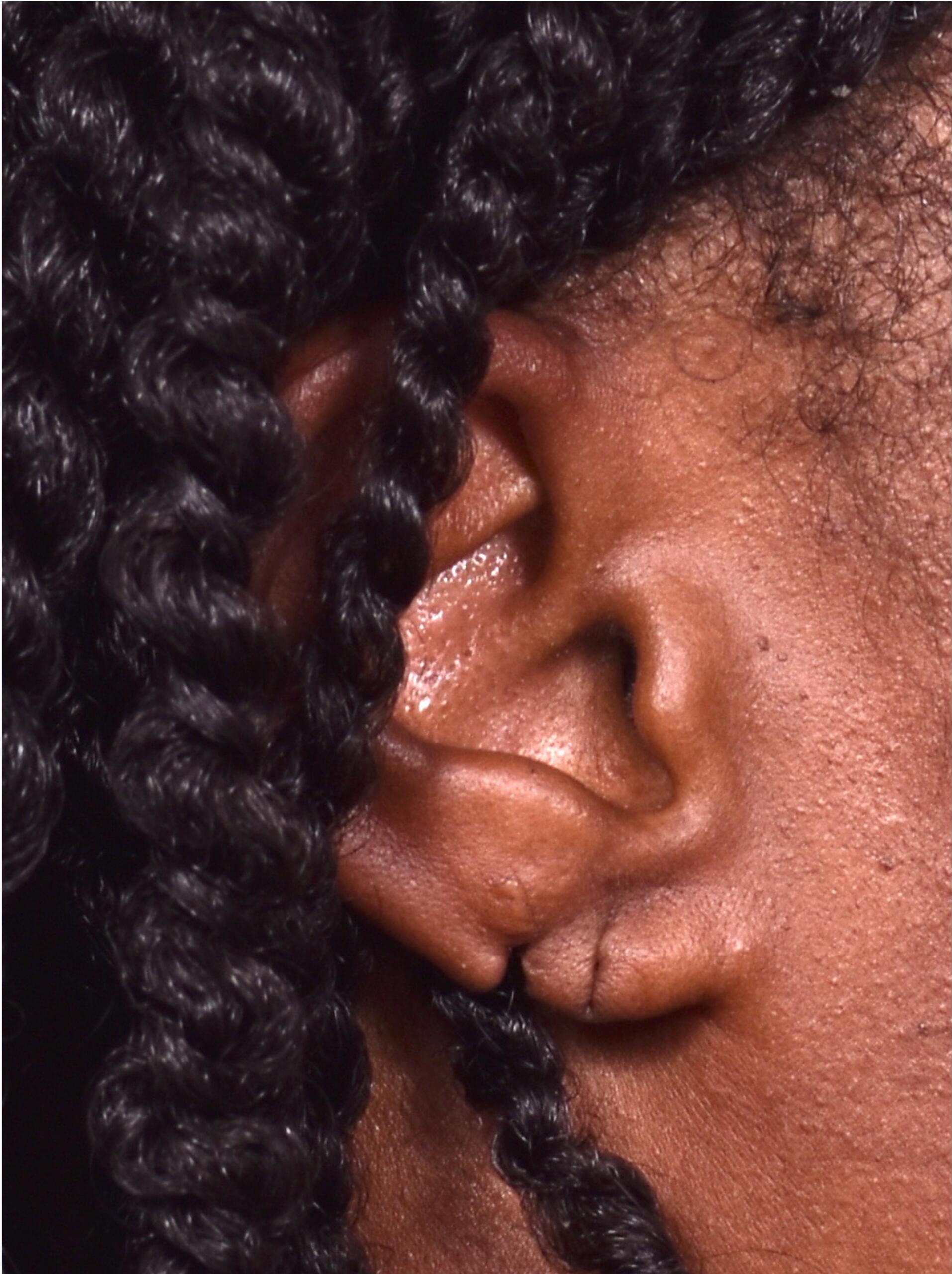 Earlobe repair torn stretched piercing Atlanta best Sandy Springs before after