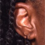 Aviva Atlanta earlobe repair before after expert best torn stretched