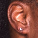 Aviva Atlanta earlobe repair before after expert best torn stretched