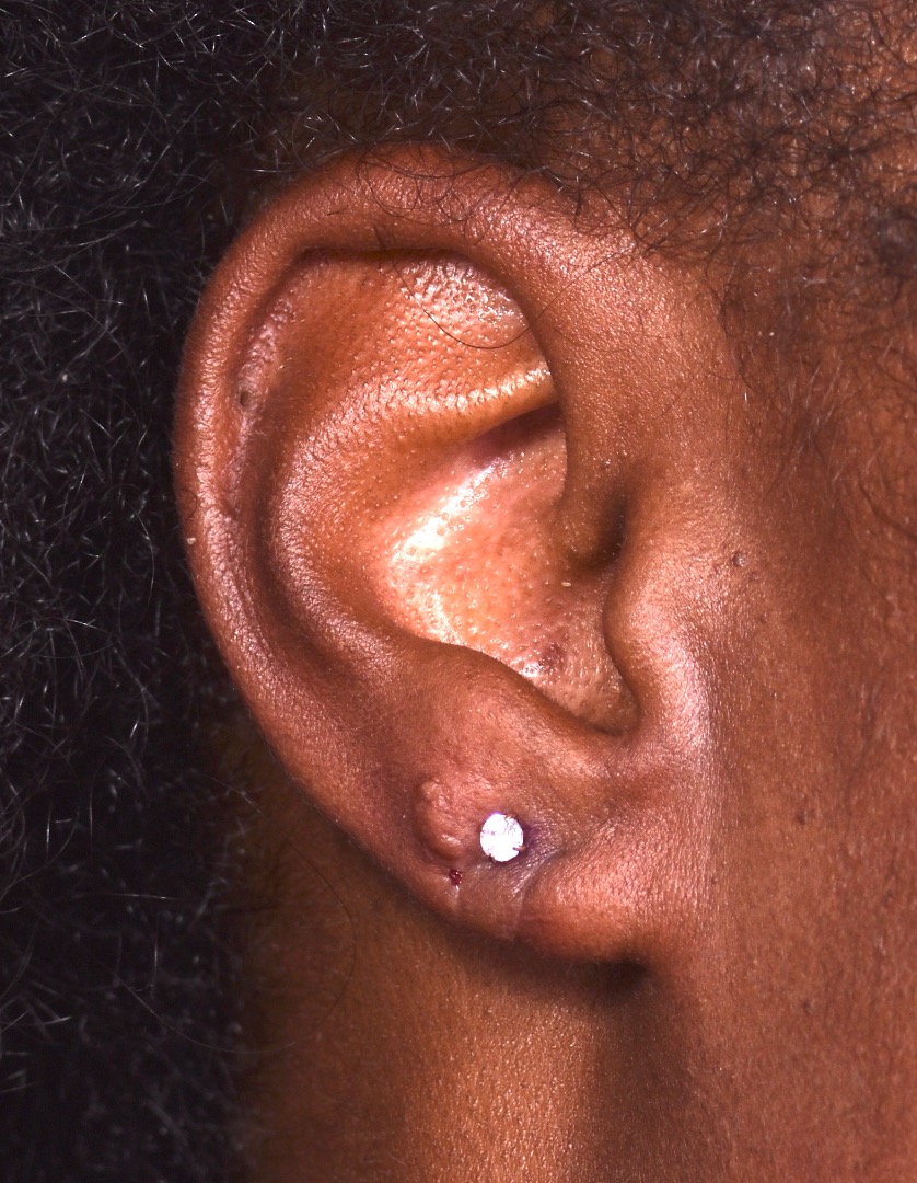 Aviva Atlanta earlobe repair before after expert best torn stretched