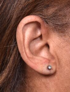 Atlanta torn earlobe repair stretched piercing