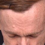 Aviva Atlanta forehead bump osteoma lipoma growth cyst hard surgery before and after