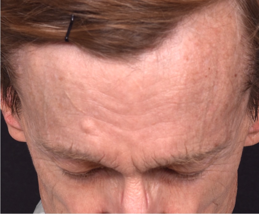 Aviva Atlanta forehead bump osteoma lipoma growth cyst hard surgery before and after