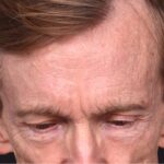 Aviva Atlanta forehead bump osteoma lipoma growth cyst hard surgery before and after