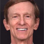 Aviva Atlanta forehea bump lipoma growth osteoma cyst hard surgery before after