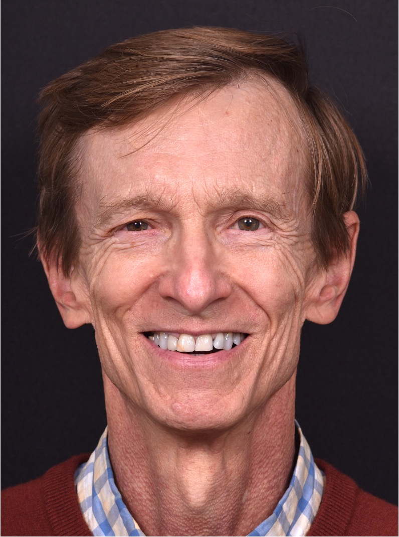 Aviva Atlanta forehea bump lipoma growth osteoma cyst hard surgery before after