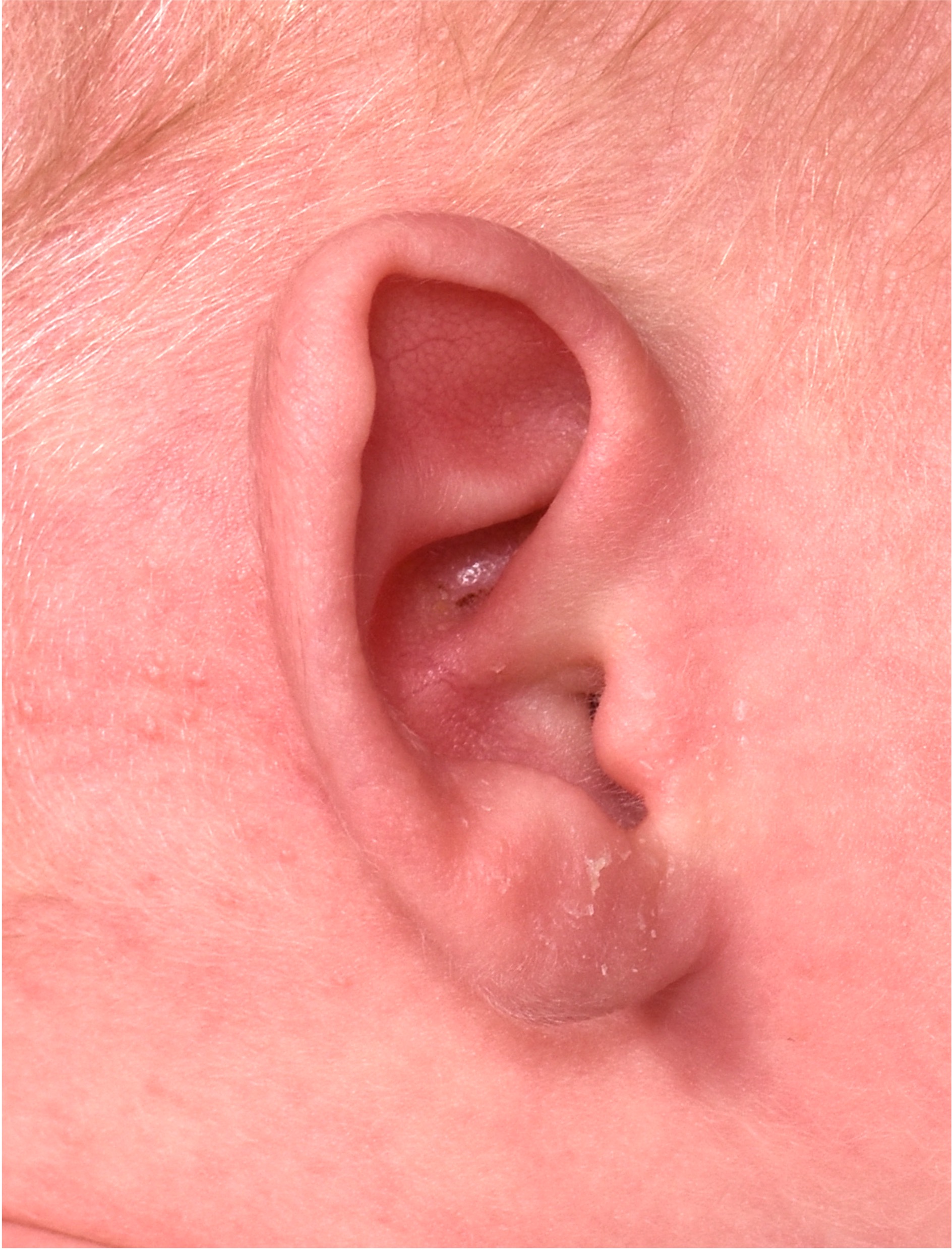 Aviva Atlanta newborn baby ear folded deformity Earwell Earbuddies best expert