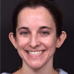 Atlanta otoplasty best before after expert top plastic surgeon ear lopear