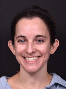 Atlanta otoplasty best before after expert top plastic surgeon ear lopear